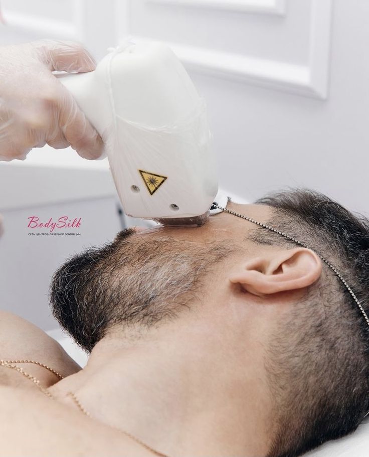 Epilation laser by sophie festre Épilation hommes visage comple